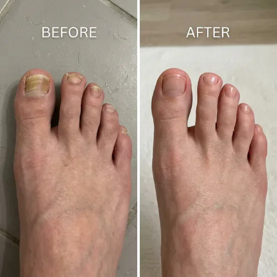 Before and after photos of toenails published by the maker of the Fungabeam Pen